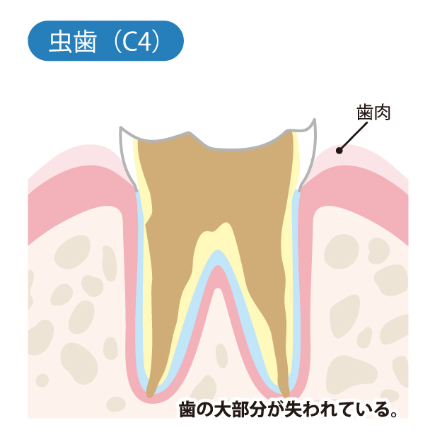 月島（中央区佃）の歯医者、佃2丁目歯科の、なるべく歯を削らない・痛みを抑えた治療