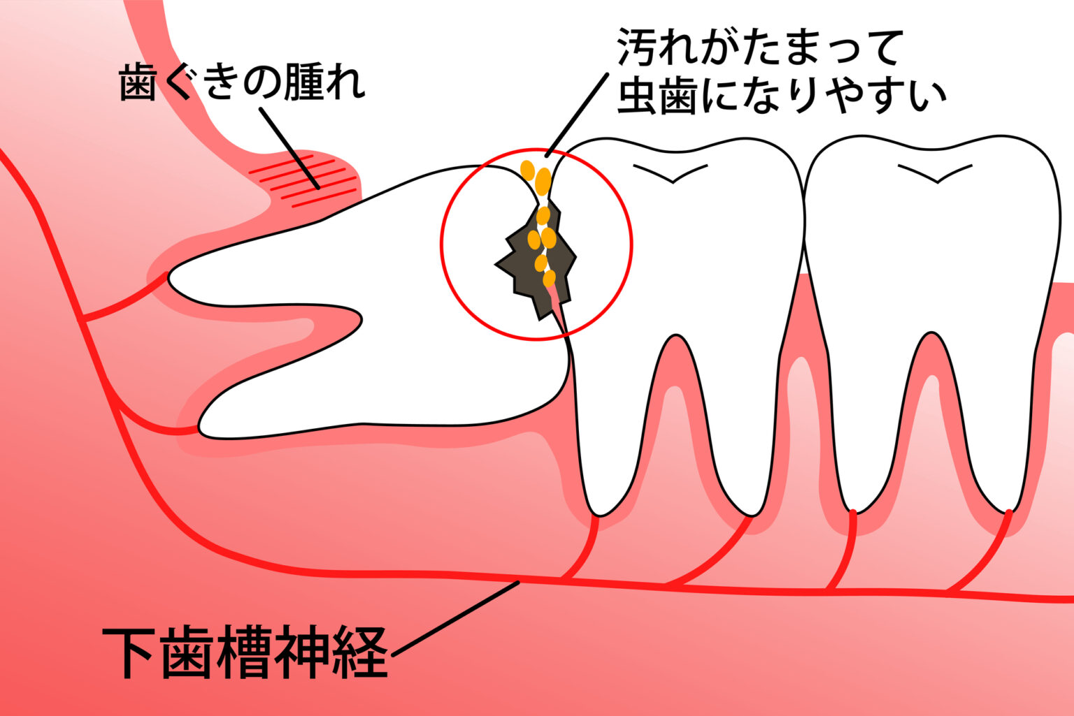 月島（中央区佃）の歯医者、佃2丁目歯科の、親知らずの抜歯