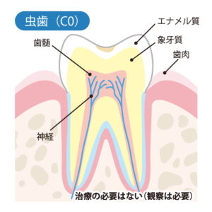 月島（中央区佃）の歯医者、佃2丁目歯科で、知覚過敏と虫歯の見分け方とは？しみ始める原因と自宅でできるケア方法を解説