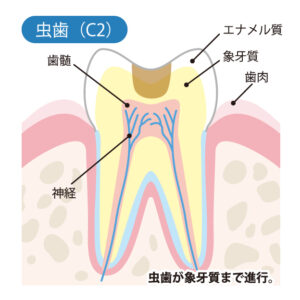 月島（中央区佃）の歯医者、佃2丁目歯科で、知覚過敏と虫歯の見分け方とは？しみ始める原因と自宅でできるケア方法を解説