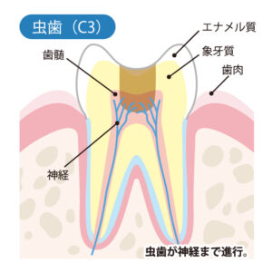 月島（中央区佃）の歯医者、佃2丁目歯科で、知覚過敏と虫歯の見分け方とは？しみ始める原因と自宅でできるケア方法を解説