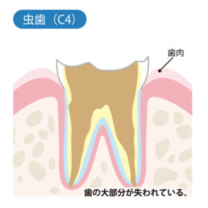 月島（中央区佃）の歯医者、佃2丁目歯科で、知覚過敏と虫歯の見分け方とは？しみ始める原因と自宅でできるケア方法を解説