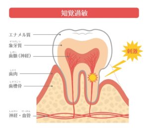 月島（中央区佃）の歯医者、佃2丁目歯科で、知覚過敏と虫歯の見分け方とは？しみ始める原因と自宅でできるケア方法を解説