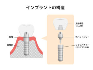 月島（中央区佃）の歯医者、佃2丁目歯科で、インプラント治療の寿命はどのくらい？長持ちさせるためのメンテナンスと注意点を解説